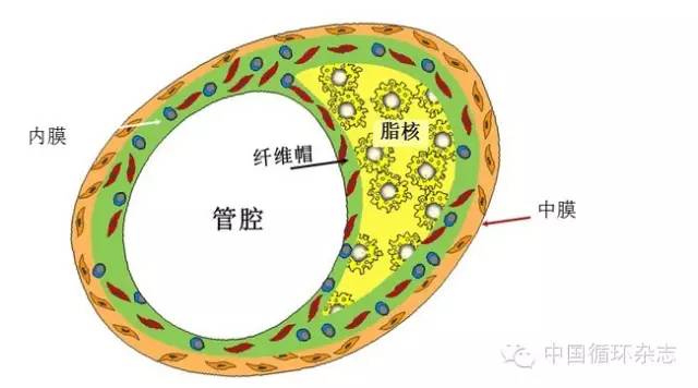纤维帽是否稳定决定了血管是否会发生意外